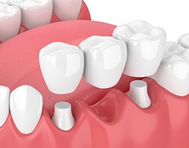 Dental bridges can sometimes be an excellent alternative to dentures