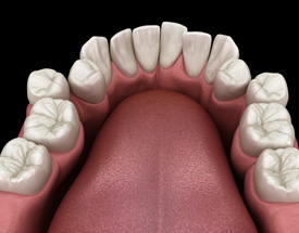 Illustration of crowded teeth