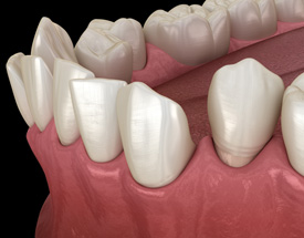 Illustration of gapped teeth