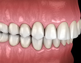 Illustration of an overbite