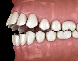 Illustration of an open bite