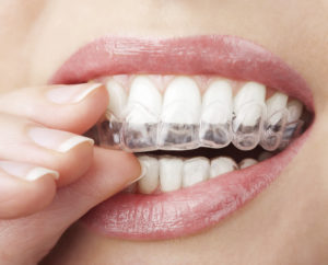 Invisalign® Clear Braces in Hickory Flat, GA - Dentistry at